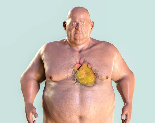 Överviktiga Människors Överviktiga Hjärta Illustration Begreppet Fetma Och Inre Organ — Stockfoto