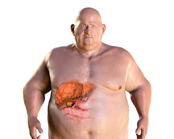 Fibrotic Liver Obese Man Illustration Concept Obesity Inner Organs Diseases — Stock Photo, Image