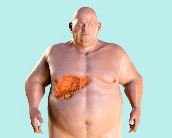 Ινωτικό Ήπαρ Παχύσαρκο Άνθρωπο Τρισδιάστατη Απεικόνιση Έννοια Της Παχυσαρκίας Και — Φωτογραφία Αρχείου