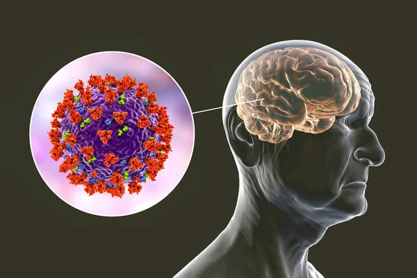 Covid Demence Neuropsychiatrické Následky Covidu Ilustrace Infekční Etiologie Demence Starší — Stock fotografie