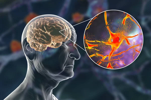 Dementia Alzheimer Disease Medical Concept Illustration Memory Loss Brain Aging — Foto de Stock