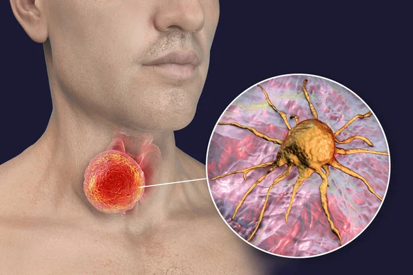 Rakovina Štítné Žlázy Ilustrace Štítné Žlázy Nádorem Lidském Těle Detailní — Stock fotografie