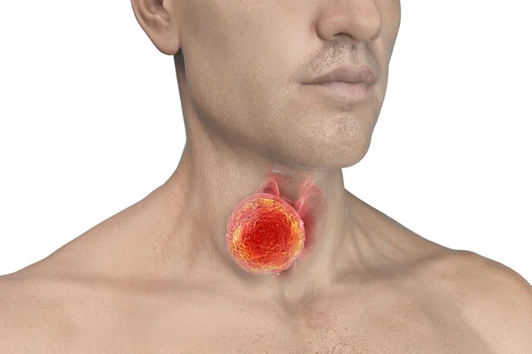 Рак Щитовидной Железы Иллюстрация Показывающая Щитовидную Железу Опухолью Внутри Человеческого — стоковое фото