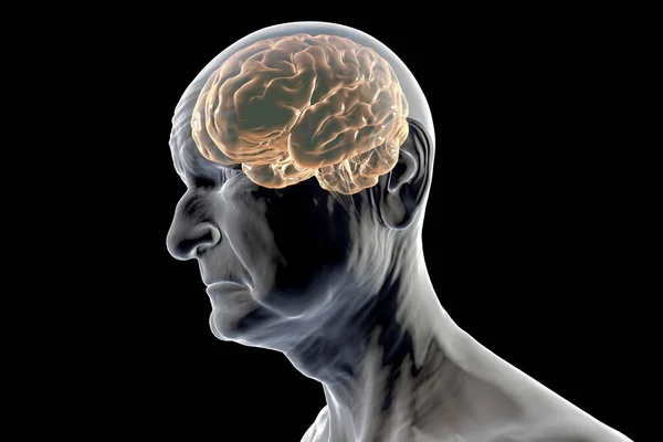An elderly person with highlighted brain. Dementia, conceptual 3D illustration showing progressive impairment of brain functions in elderly age.