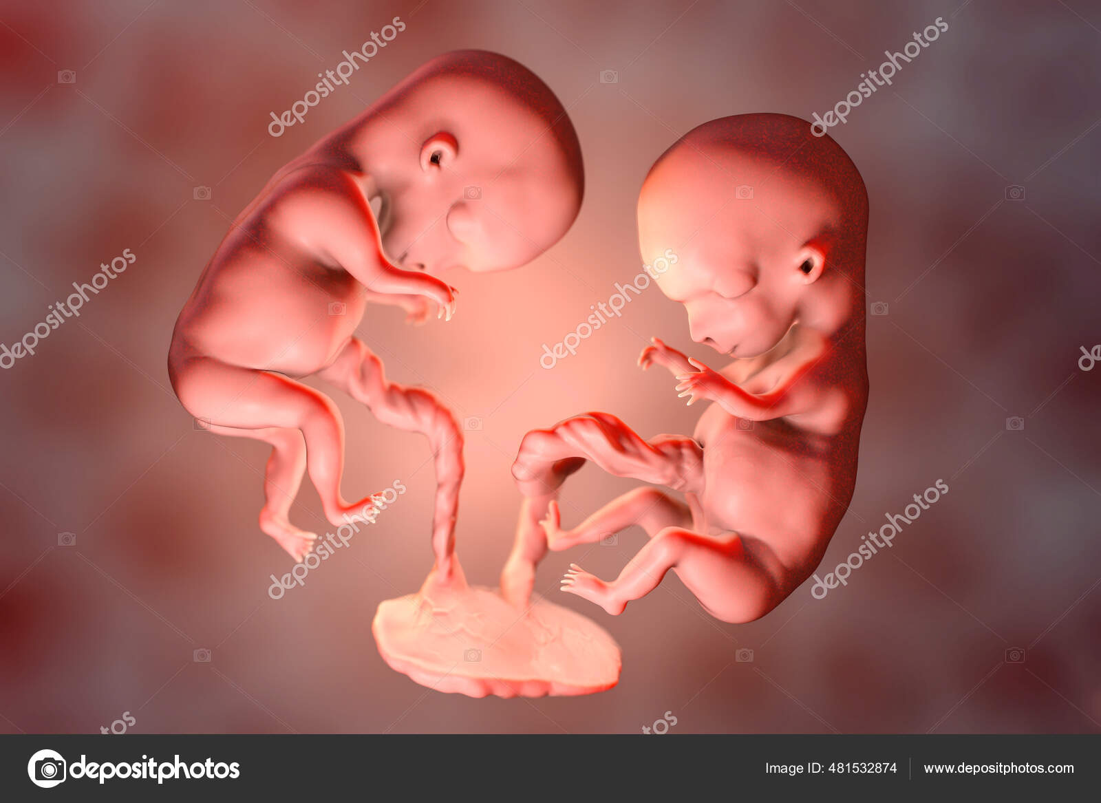 Gêmeos Monozigóticos Útero Com Placenta Única Ilustração Medicamente