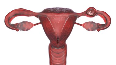 Tüplü dış gebelik, 3 boyutlu illüstrasyon, dölyatağı tüpüne rahim yerine 8 haftalık insan embriyosu yerleştirildiğini gösteriyor.