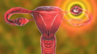 Tubal ectopic pregnancy, 3D illustration showing an 8-week human fetus implanted in the fallopian tube instead of uterus clipart