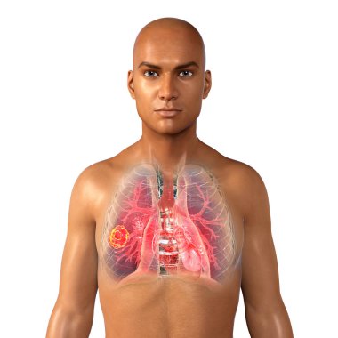 Akciğer mukozu. Mantar Mucor 'un sebep olduğu bir akciğer hastalığı. Ayrıca siyah mantar ve sarı mantar olarak da bilinir. Covid-19 komplikasyonu