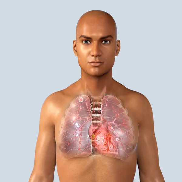 Sekundär Tuberkulos Lungorna Apikal Knöl Illustration Lungtuberkulos — Stockfoto