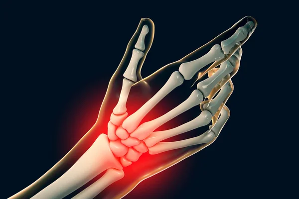 Painful Hand Pain Palm Wrist Illustration Showing Human Hand Skeleton — Stock Photo, Image