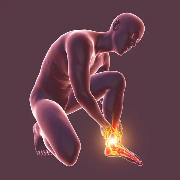 Bolest Nohou Kotníků Konceptuální Ilustrace Anatomie Nohou Achillova Bolest Patě — Stock fotografie
