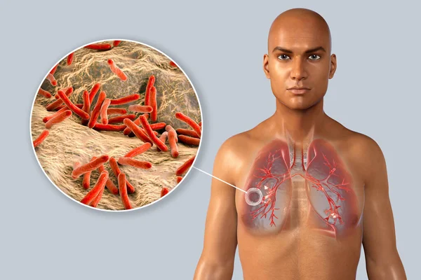 Lung Tuberculosis Close View Bacteria Mycobacterium Tuberculosis Illustration Tuberculous Cavern — Stock Photo, Image