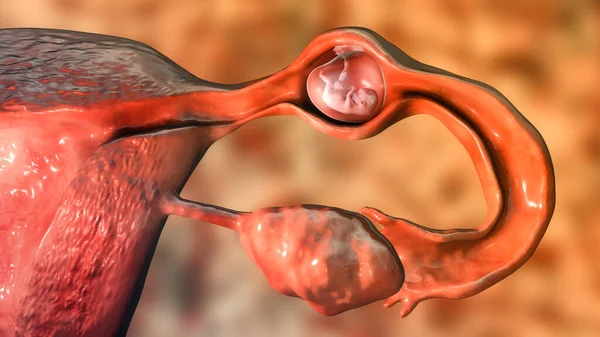 Tubal ectopic pregnancy, 3D illustration showing an 8-week human embryo implanted in the fallopian tube instead of uterus