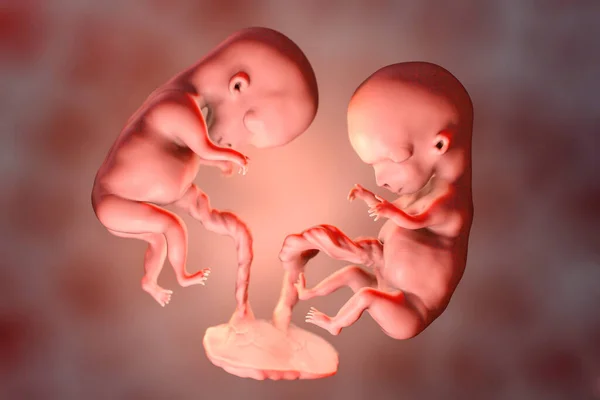 Monozygotic Twins Uterus Single Placenta Medically Accurate Illustration Human Twin — Stock Photo, Image