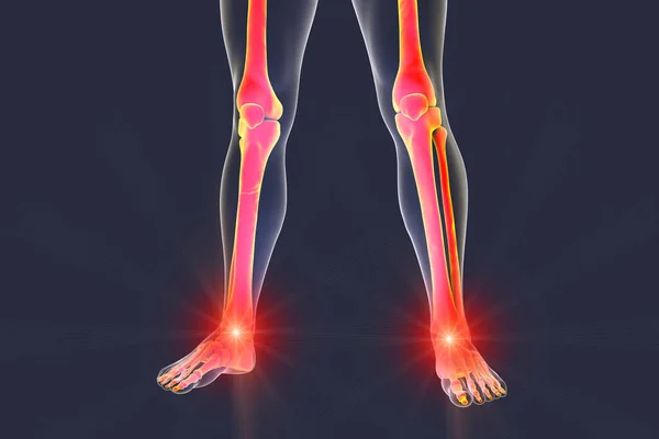 脚和脚踝疼痛 3D插图 脚和腿解剖 脚后跟刺 — 图库照片