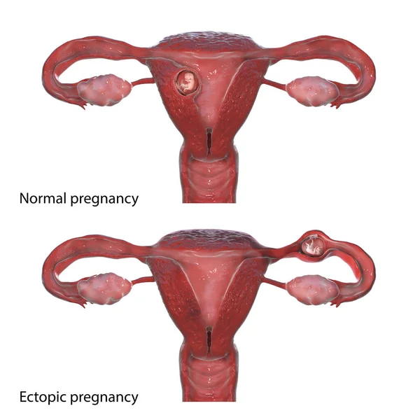 Κανονική Εγκυμοσύνη Επάνω Και Σωληναριακή Έκτοπη Εγκυμοσύνη Κάτω Τρισδιάστατη Απεικόνιση — Φωτογραφία Αρχείου