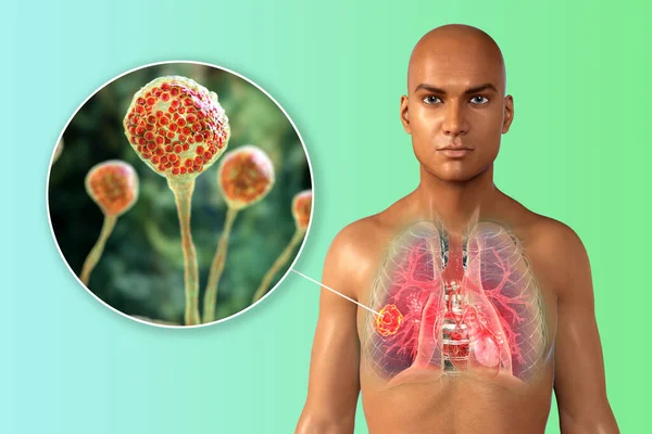 Lung mucormycosis, a lung disease caused by fungi Mucor, also known as black fungus and yellow fungus, with close-up view of the fungi, 3D illustration. Covid-19 complication