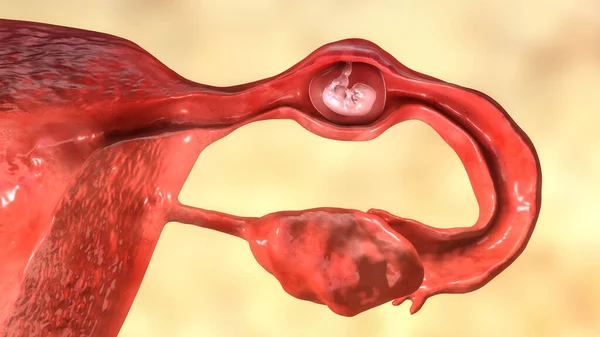输卵管异位妊娠 3D图像显示一个7周的人类胚胎植入输卵管而不是子宫 — 图库照片