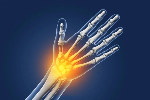 Painful Hand Pain Palm Wrist Illustration Showing Human Hand Skeleton — Stock Photo, Image