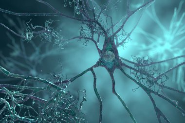 Neurons in dementia. Alzheimer's disease, Huntington's disease. 3D illustration showing amyloid plaques in brain tissue, neurofibrillary tangles and distruction of neuronal networks clipart