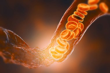 Vasokonstrüksiyon, daralmış kan damarlarından akan kırmızı kan hücreleri, üç boyutlu illüstrasyon. Beyin vazospazmı felç ya da kalp damarı damar tıkanıklığına yol açar ve miyokard enfarktüsüne yol açar.