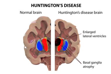 Huntington hastalığındaki koronal beyin bölümleri yan ventriküllerin genişlemiş ön boynuzlarını, sırt striatumunun dejenerasyonunu ve körelmesini gösteriyor.