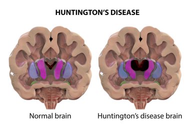 Huntington hastalığındaki koronal beyin bölümleri yan ventriküllerin genişlemiş ön boynuzlarını, sırt striatumunun dejenerasyonunu ve körelmesini gösteriyor.
