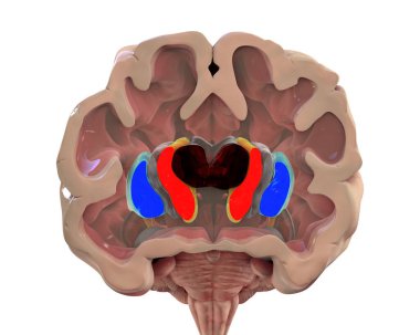 Huntington hastalığı olan birinin beyninin koronal bölümünde yanal ventriküllerin genişlemiş ön boynuzları, sırt striatumunun dejenerasyonu ve körelmesi, 3 boyutlu illüstrasyon görülüyor.