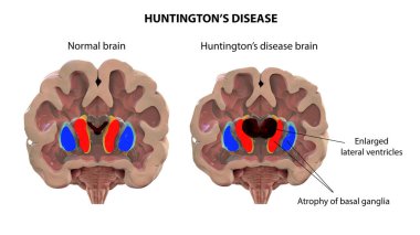 Huntington hastalığındaki koronal beyin bölümleri yan ventriküllerin genişlemiş ön boynuzlarını, sırt striatumunun dejenerasyonunu ve körelmesini gösteriyor.