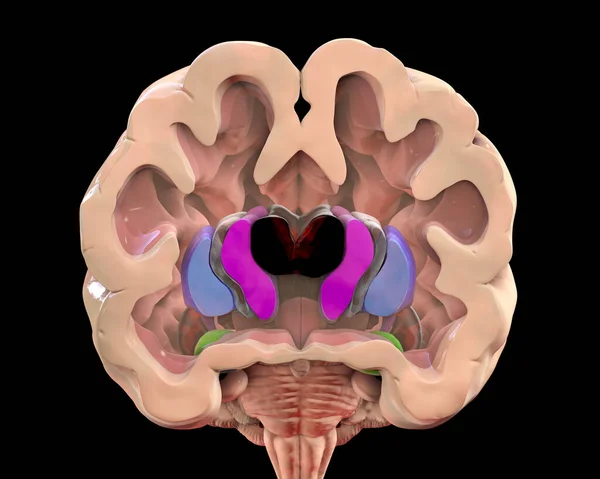 Sección Coronal Cerebro Una Persona Con Enfermedad Huntington Que Muestra —  Fotos de Stock