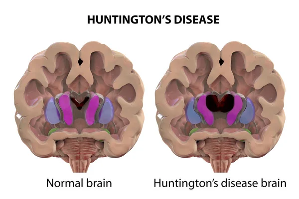 Koronala Sektioner Frisk Hjärna Och Hjärna Vid Huntingtons Sjukdom Som — Stockfoto