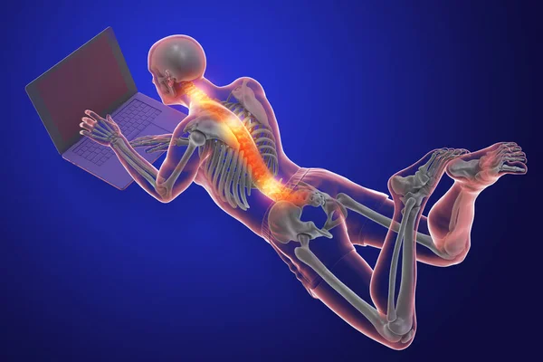 Working with laptop in a wrong position. Concept of backache, back pain. 3D illustration showing male body with highlighted skeleton working in a wrong position