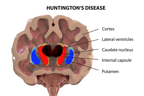 Coronal section of a brain of a person with Huntington\'s disease showing enlarged anterior horns of the lateral ventricles, degeneration and atrophy of the dorsal striatum, labelled 3D illustration