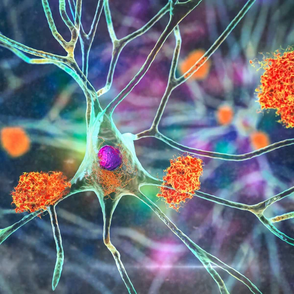 Neuronas Enfermedad Alzheimer Ilustración Que Muestra Placas Amiloides Tejido Cerebral — Foto de Stock