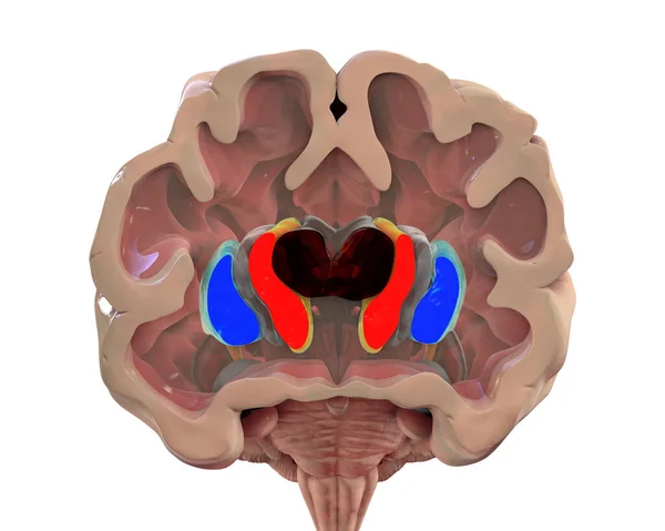 Sección Coronal Cerebro Una Persona Con Enfermedad Huntington Que Muestra — Foto de Stock