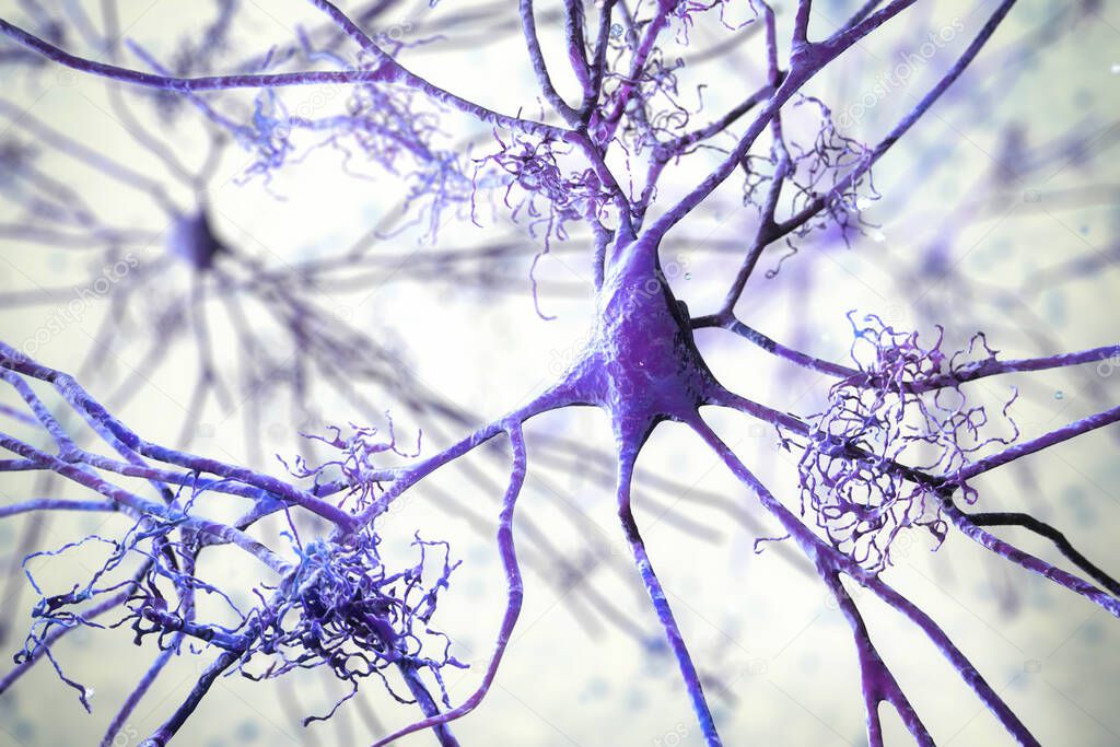 Neurons in dementia. Alzheimer's disease, Huntington's disease, other types of dementia. Degradation of neuronal networks, formation of amyloid plaques, 3D illustration