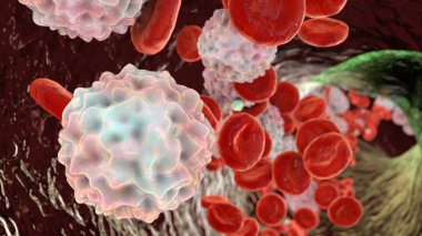 Lymphocytosis, leukocytosis, 3D illustration showing abundant white blood cells inside blood vessel clipart