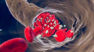 Alyuvar, trombosit ve fibrin protein iplikçiklerinden oluşan kan pıhtısı. Thrombus, 3 boyutlu illüstrasyon