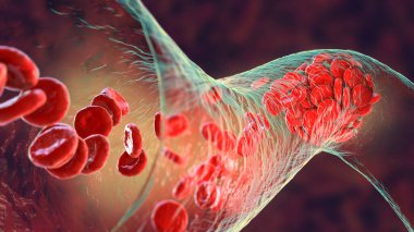 Alyuvar, trombosit ve fibrin protein iplikçiklerinden oluşan kan pıhtısı. Thrombus, 3 boyutlu illüstrasyon