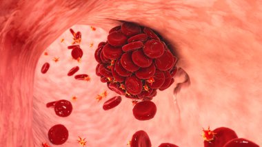 Hasarlı kan damarlarındaki kan pıhtısı kırmızı kan hücreleri, trombositler ve fibrin protein iplikçiklerinden oluşuyor. Thrombus, 3 boyutlu illüstrasyon