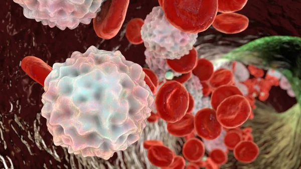 Linfocitose Leucocitose Ilustração Mostrando Glóbulos Brancos Abundantes Dentro Vaso Sanguíneo — Fotografia de Stock