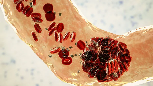 Θρόμβος Αίματος Από Ερυθρά Αιμοσφαίρια Αιμοπετάλια Και Ινώδεις Πρωτεϊνικές Ίνες — Φωτογραφία Αρχείου
