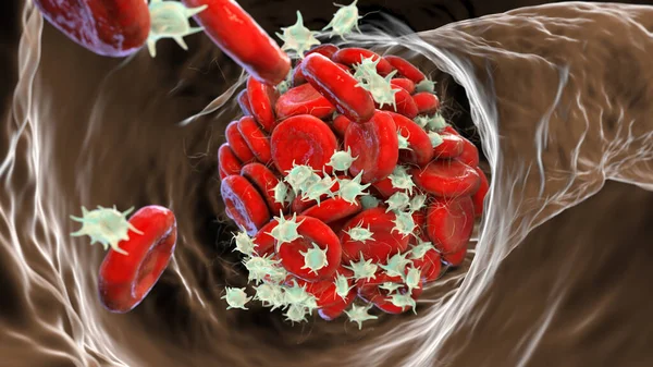 Blutgerinnsel Aus Roten Blutkörperchen Blutplättchen Und Fibrin Proteinsträngen Thrombus Illustration — Stockfoto