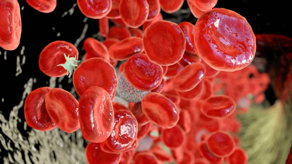 Polycythemia Vera Rzadki Wolno Rosnący Rak Krwi Wzrostem Liczby Czerwonych — Zdjęcie stockowe