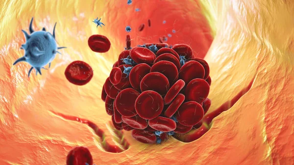 Blood clot in damaged blood vessel made of red blood cells, platelets and fibrin protein strands. Thrombus, 3D illustration