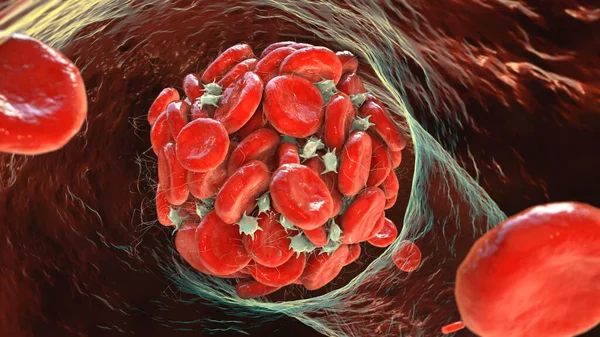 血凝块由红细胞 血小板和纤维蛋白链构成 Thrombus 3D插图 — 图库照片