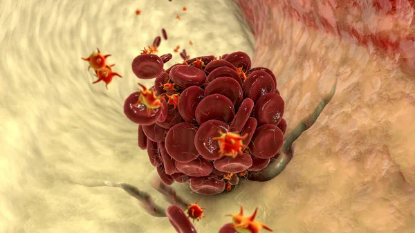 Blood Clot Damaged Blood Vessel Made Red Blood Cells Platelets — Stock Photo, Image