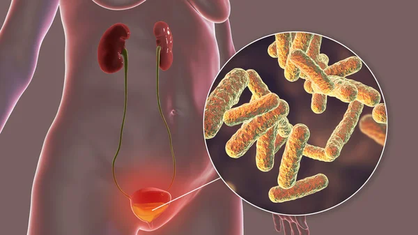 Cistitis Infección Bacteriana Vejiga Urinaria Ilustración Conceptual Que Muestra Bacterias — Foto de Stock