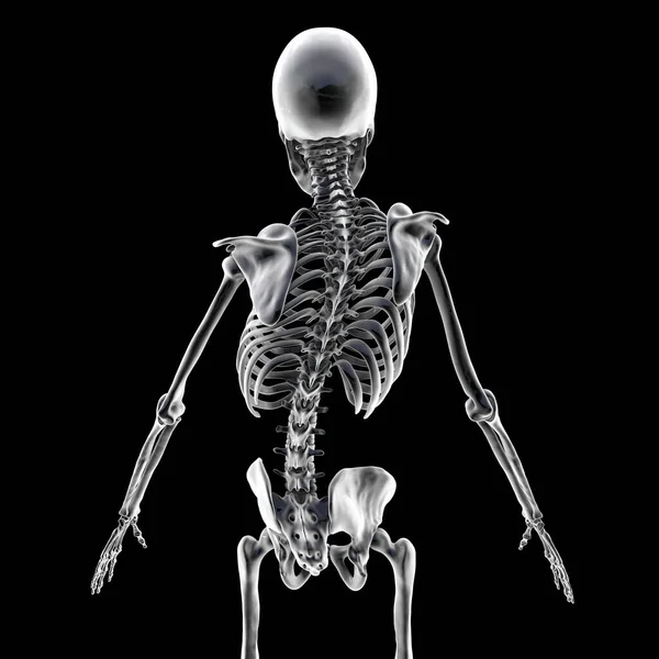 Scoliosis 3D插图 人的骨骼 有弯曲的脊椎 不均匀的肩膀和臀部 — 图库照片