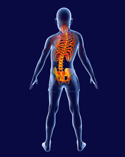 Escoliosis Ilustración Cuerpo Humano Con Columna Vertebral Curvada Hombros Desiguales — Foto de Stock